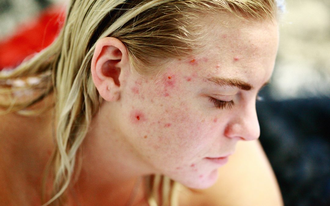 5 conseils éprouvés qui vous aideront à prévenir les poussées d’acné