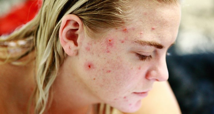 5 conseils éprouvés qui vous aideront à prévenir les poussées d’acné
